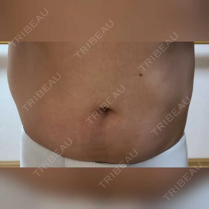 脂肪冷却（お腹） みずほクリニック DAY 8 メイン用