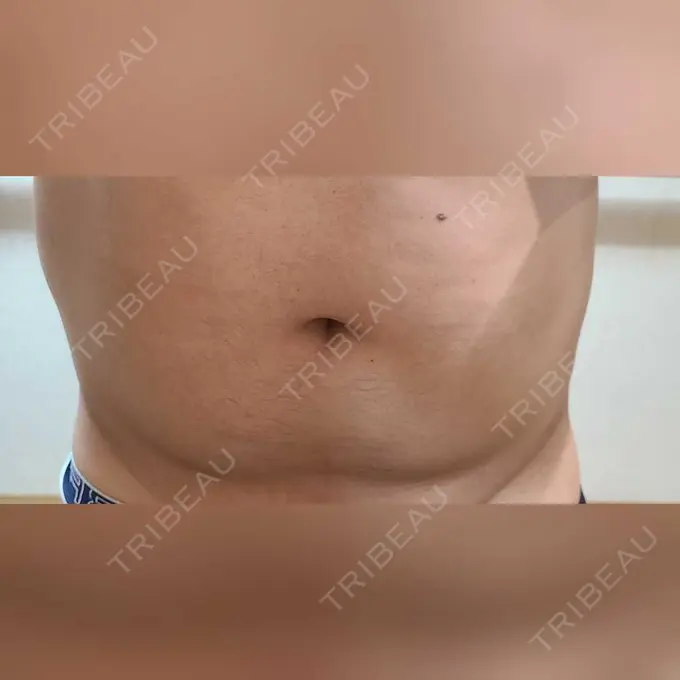 脂肪冷却（お腹） みずほクリニック DAY 9 メイン用