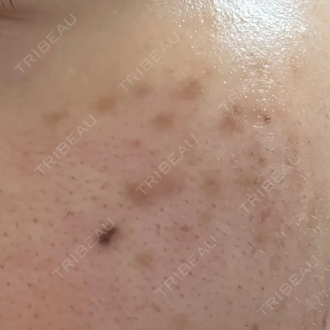 ピコスポット LOUIS CLINIC 二子玉川院【ルイクリニック】 DAY 23 メイン用