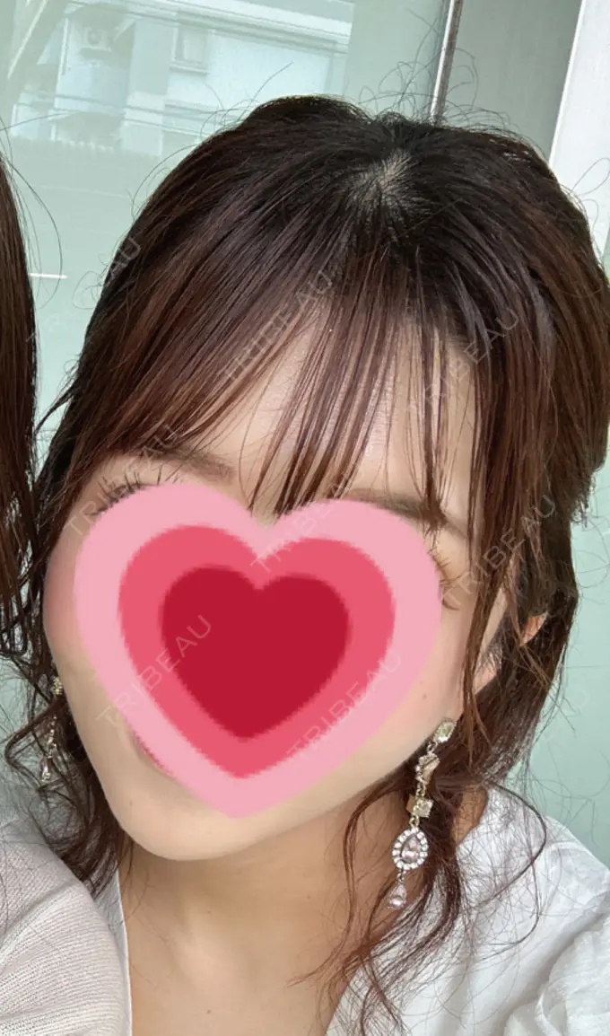 脂肪吸引（顔） / ジョールファット除去 / ボトックス（エラ・小顔） Otus Clinic 【オータスクリニック】 DAY 111 メイン用