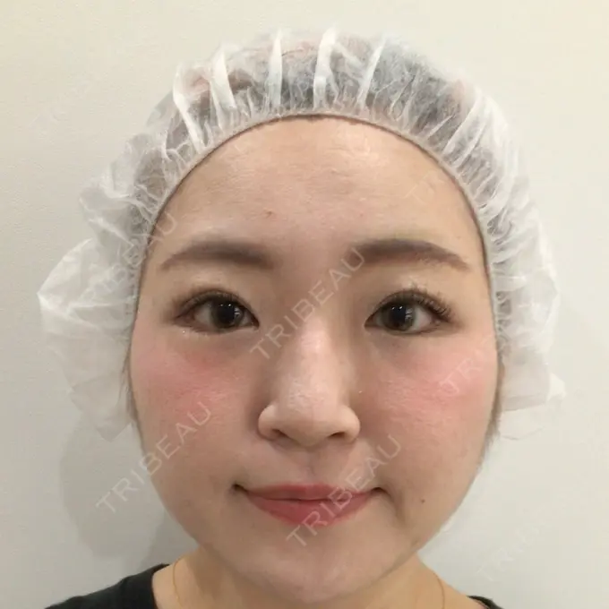 二重埋没 HAAB BEAUTY CLINIC 横浜院 AFTER メイン用