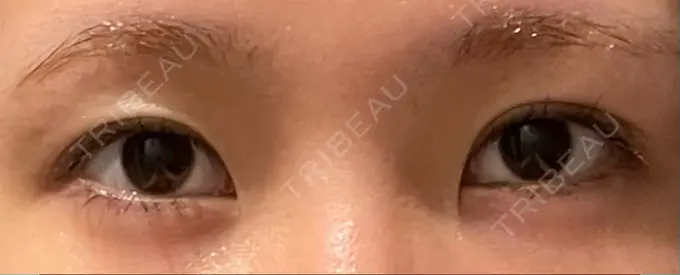 二重埋没 yuzawa clinic AFTER メイン用