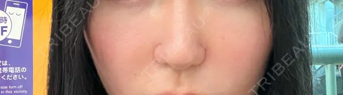 小鼻縮小（切開） / 鼻翼挙上 東京美容医療クリニック 池袋院 DAY 35 メイン用