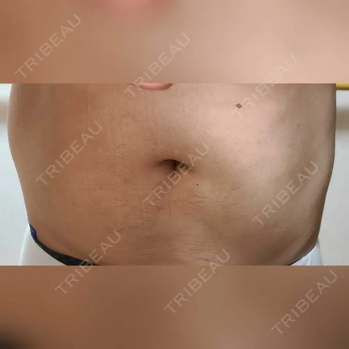 脂肪冷却（お腹） みずほクリニック DAY 10 メイン用