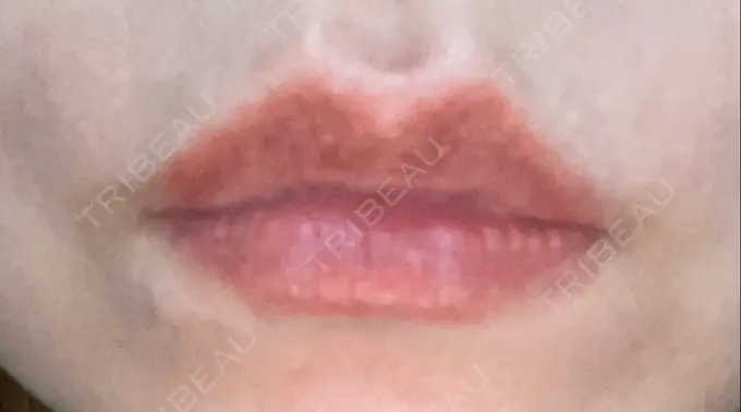 アートメイク（唇） LEAGRANT CLINIC 中目黒 AFTER メイン用