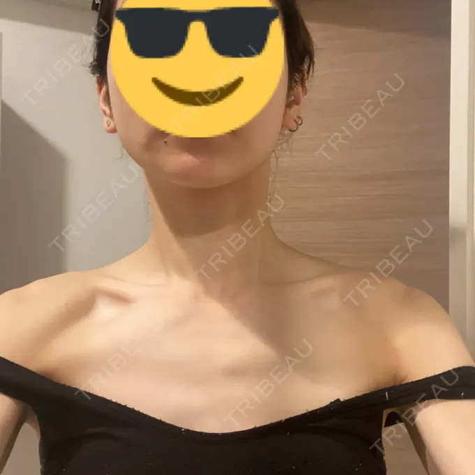 ボトックス（エラ・小顔） / ボトックス（肩） / ボトックス（首） AYANAフィラーズクリニック 渋谷院 DAY 1 メイン用