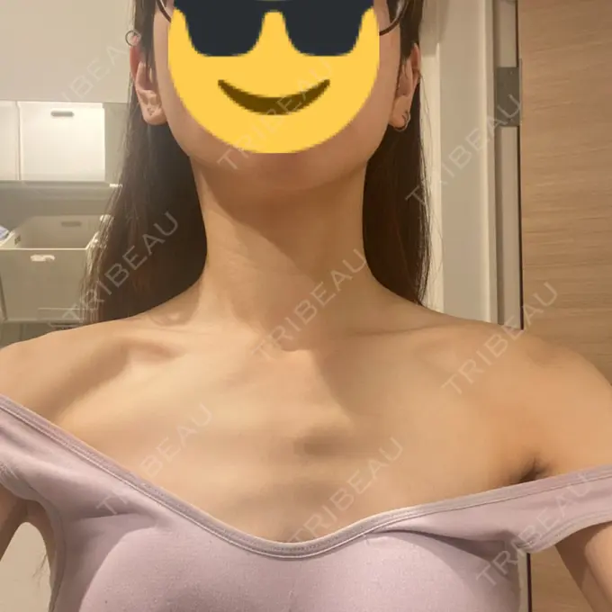 ボトックス（エラ・小顔） / ボトックス（肩） / ボトックス（首） AYANAフィラーズクリニック 渋谷院 DAY 2 メイン用