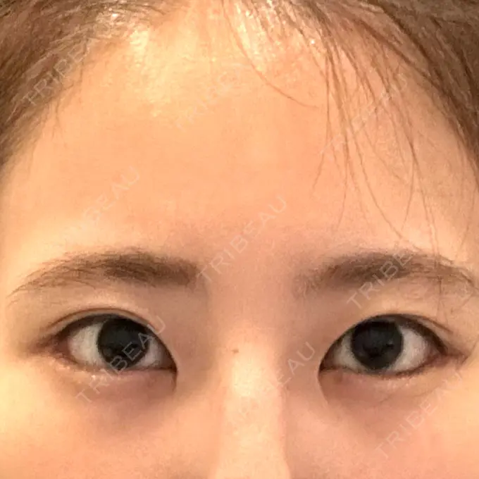 タレ目形成・グラマラスライン（切開） 銀座マイアミ美容外科 AFTER メイン用