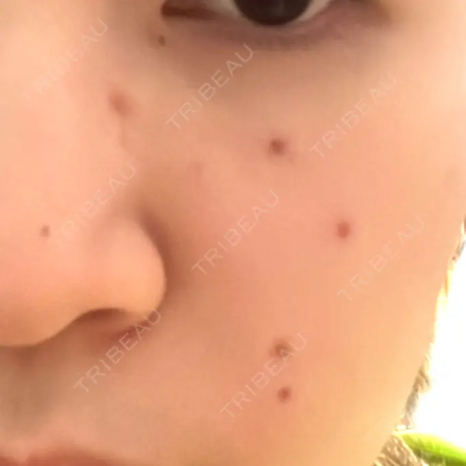 ほくろ・いぼ除去レーザー（肌） Fellez Clinic【フェルズクリニック】 DAY 2 メイン用