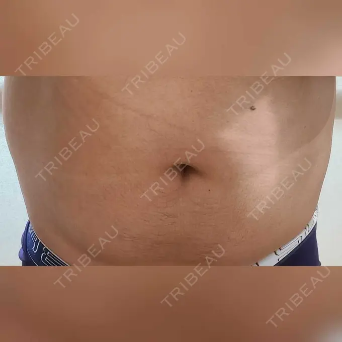 脂肪冷却（お腹） みずほクリニック AFTER メイン用