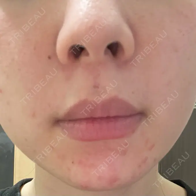 ピーリング（ニキビ・毛穴） / 光治療（フォトフェイシャルなど） MKクリニック 日本橋院 DAY 2 メイン用