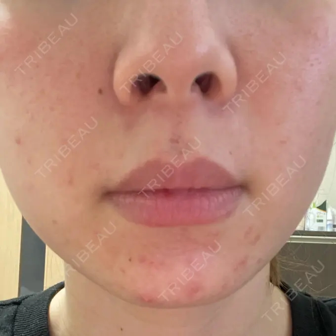 ピーリング（ニキビ・毛穴） / 光治療（フォトフェイシャルなど） MKクリニック 日本橋院 DAY 3 メイン用