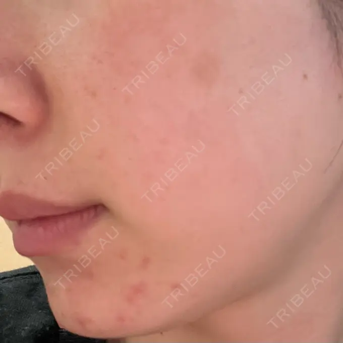 ピーリング（ニキビ・毛穴） / 光治療（フォトフェイシャルなど） MKクリニック 日本橋院 DAY 3 メイン用