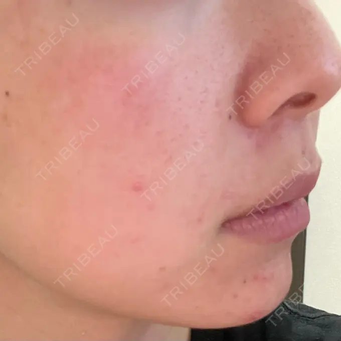 ピーリング（ニキビ・毛穴） / 光治療（フォトフェイシャルなど） MKクリニック 日本橋院 DAY 3 メイン用