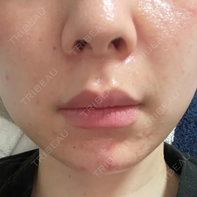 ピーリング（ニキビ・毛穴） / 光治療（フォトフェイシャルなど） MKクリニック 日本橋院 DAY 4 メイン用