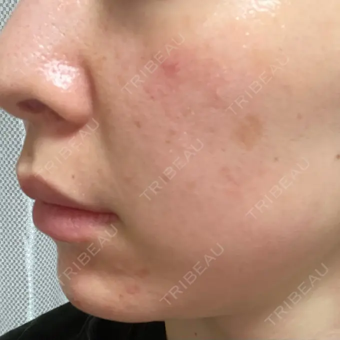 ピーリング（ニキビ・毛穴） / 光治療（フォトフェイシャルなど） MKクリニック 日本橋院 DAY 4 メイン用