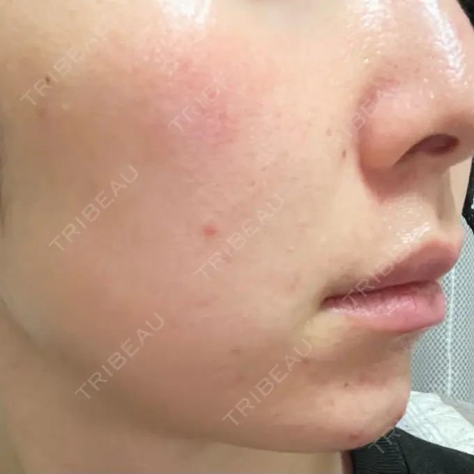 ピーリング（ニキビ・毛穴） / 光治療（フォトフェイシャルなど） MKクリニック 日本橋院 DAY 4 メイン用