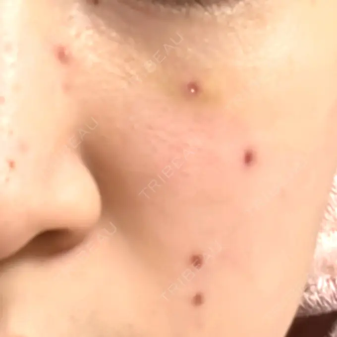 ほくろ・いぼ除去レーザー（肌） Fellez Clinic【フェルズクリニック】 DAY 3 メイン用