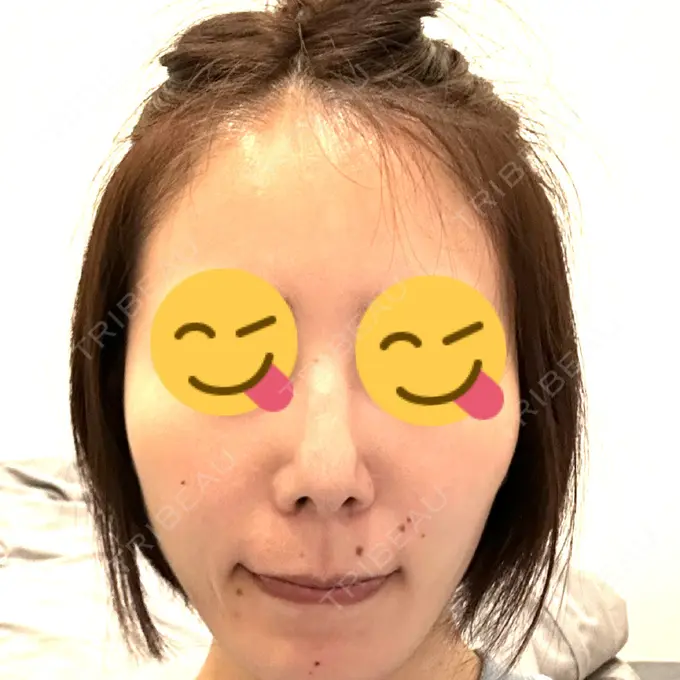 軟骨移植 / 骨切幅寄せ / ワシ鼻修正・ハンプ切除 / 鼻尖形成（非切開） 銀座マイアミ美容外科 AFTER メイン用