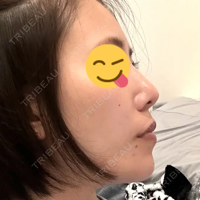 軟骨移植 / 骨切幅寄せ / ワシ鼻修正・ハンプ切除 / 鼻尖形成（非切開） 銀座マイアミ美容外科 DAY 175 メイン用