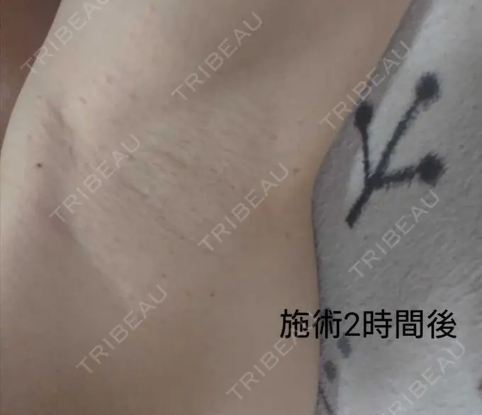 ワキ汗治療（ボトックス） 大阪TAクリニック DAY 0 メイン用