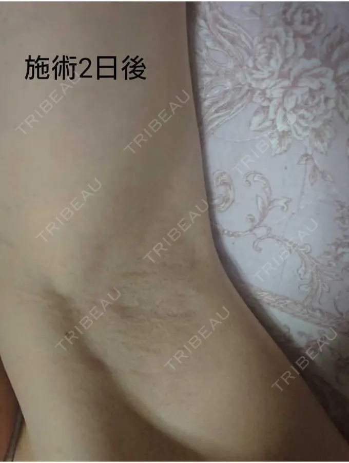 ワキ汗治療（ボトックス） 大阪TAクリニック DAY 2 メイン用