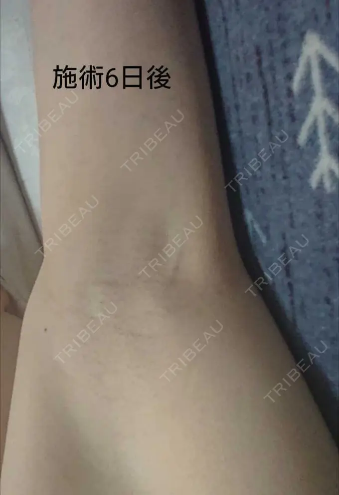 ワキ汗治療（ボトックス） 大阪TAクリニック AFTER メイン用