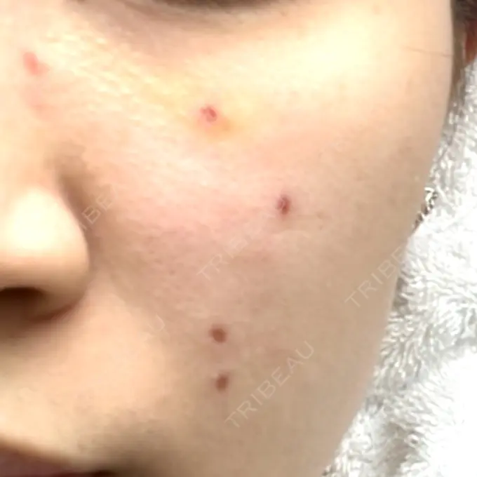 ほくろ・いぼ除去レーザー（肌） Fellez Clinic【フェルズクリニック】 DAY 4 メイン用