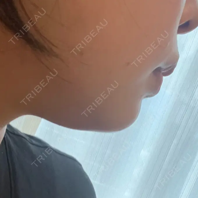 ハイフ（顔） A CLINIC（エークリニック） 仙台院 DAY 26 メイン用