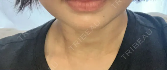 ハイフ（顔） A CLINIC（エークリニック） 仙台院 DAY 26 メイン用