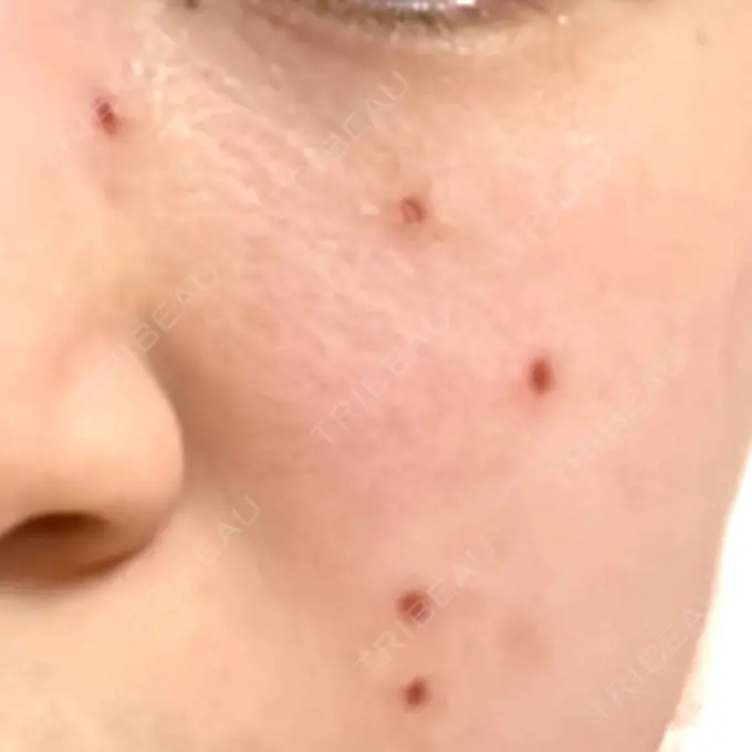 ほくろ・いぼ除去レーザー（肌） Fellez Clinic【フェルズクリニック】 DAY 5 メイン用