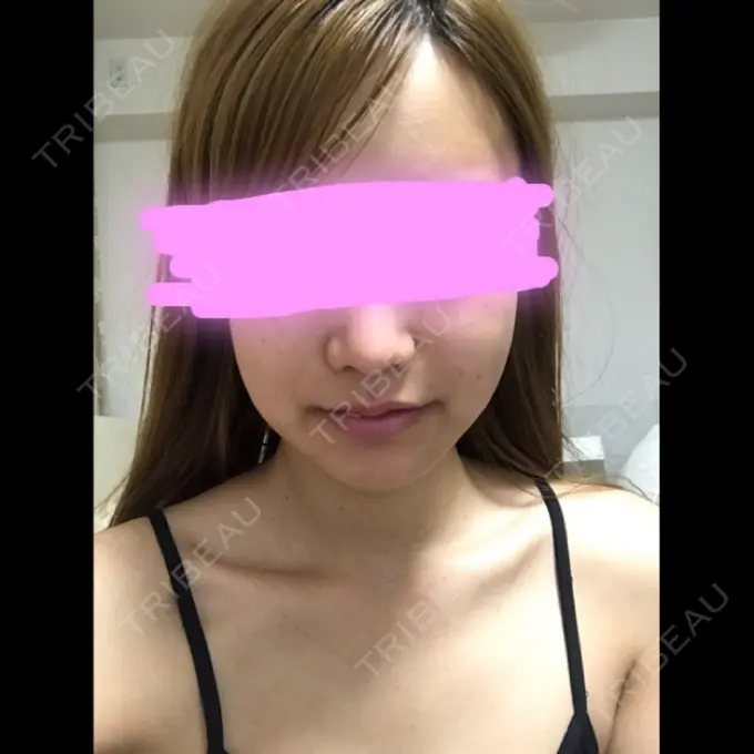 骨削り（エラ） / 骨削り（頬） / 目尻切開 / タレ目形成・グラマラスライン（切開） / 輪郭修正 / その他（輪郭） ウォンジン（Wonjin）整形外科 DAY 24 メイン用