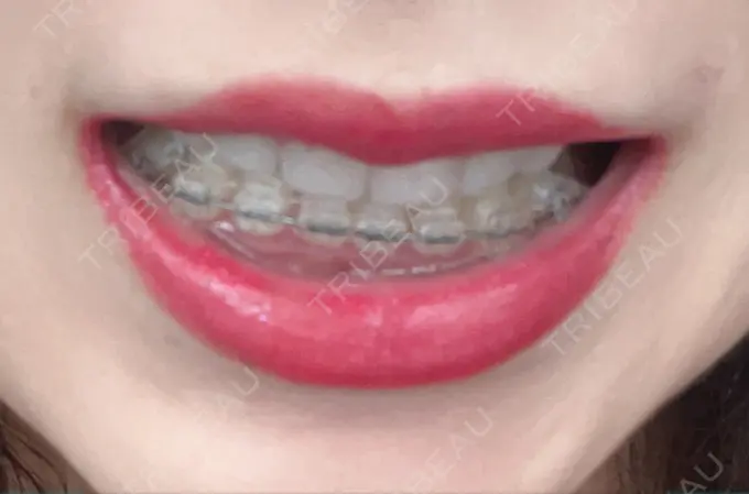 ガミースマイル手術 / 矯正（ワイヤー） / セラミック / その他（審美歯科/矯正歯科） 東京銀座A CLINIC デンタル DAY 253 メイン用