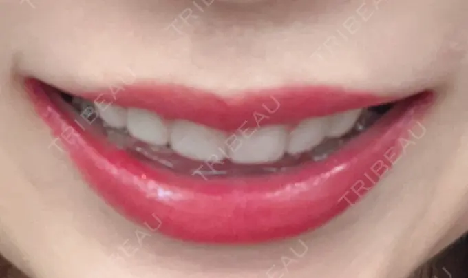 ガミースマイル手術 / 矯正（ワイヤー） / セラミック / その他（審美歯科/矯正歯科） 東京銀座A CLINIC デンタル DAY 253 メイン用