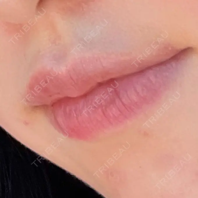 ヒアルロン酸注入（涙袋） / 肌ヒアルロン酸注入（たるみ・シワ改善） / ヒアルロン酸注入（唇） LA CLEF CLINIC（ラクレクリニック） AFTER メイン用