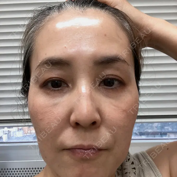 ピーリング（ハリ・ツヤ） 大塚美容形成外科 横浜院 DAY 1 メイン用