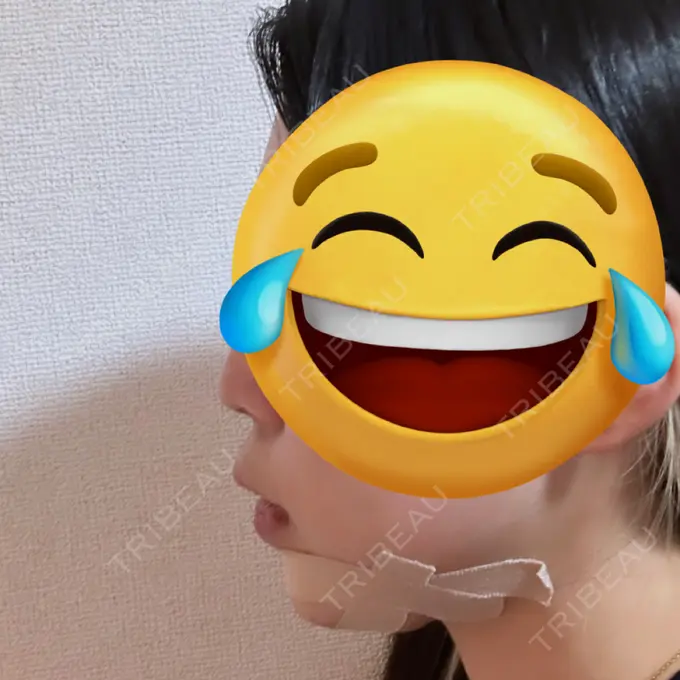 あごプロテーゼ / その他（輪郭） WOM CLINIC GINZA （ワム クリニック ギンザ） DAY 1 メイン用