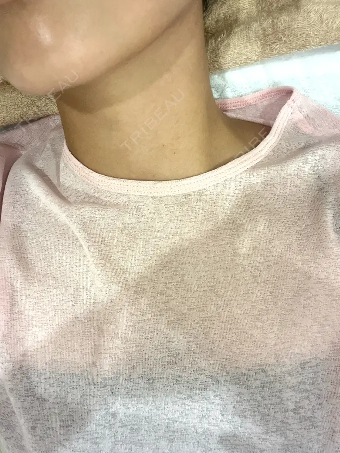 ハイフ（顔） HAAB BEAUTY CLINIC 横浜院 DAY 0 メイン用