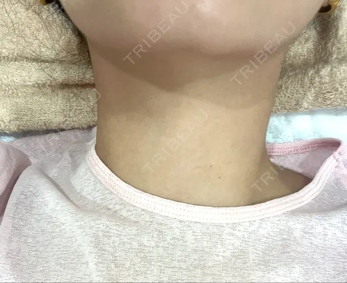 ハイフ（顔） HAAB BEAUTY CLINIC 横浜院 DAY 0 メイン用