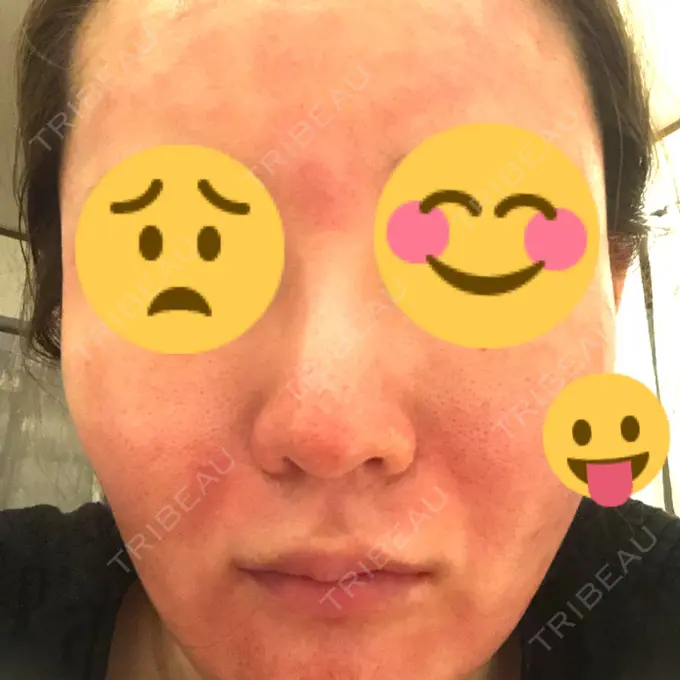 ベビーコラーゲン / ダーマペン ルラ美容クリニック 渋谷本院 DAY 0 メイン用