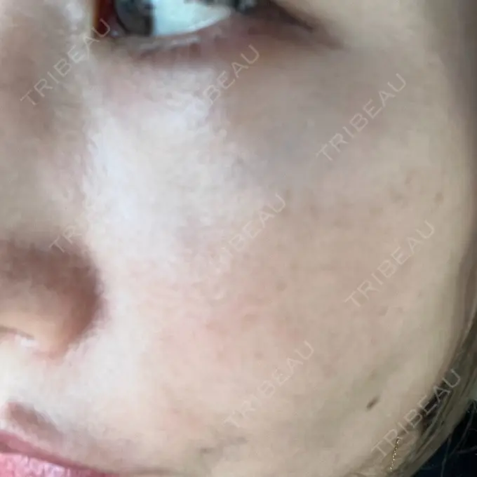 ピコレーザートーニング（美白・肝斑） エースクリニック 大阪梅田HEPナビオ院 AFTER メイン用