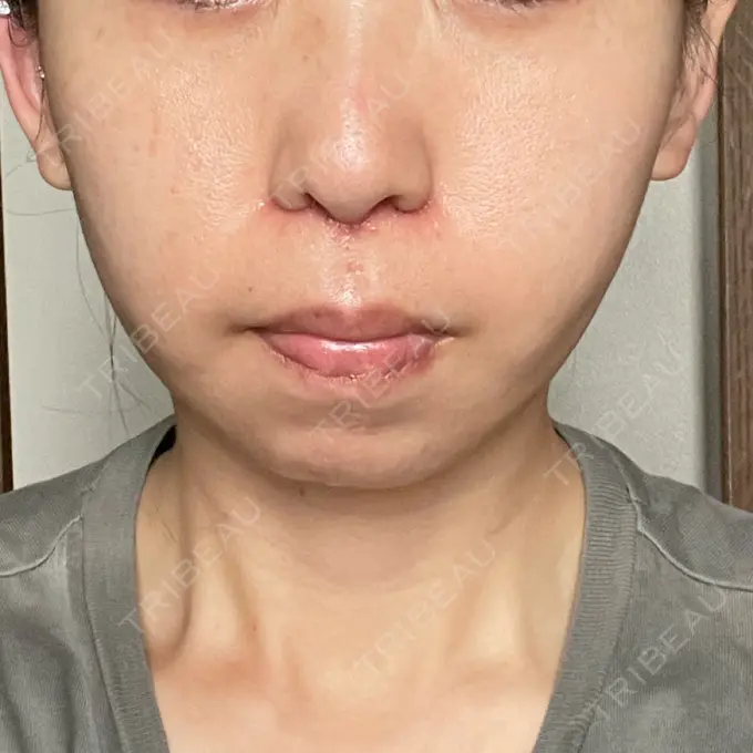 小鼻縮小（切開） / 鼻翼挙上 Otus Clinic 【オータスクリニック】 DAY 14 メイン用