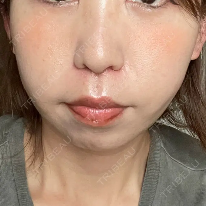 小鼻縮小（切開） / 鼻翼挙上 Otus Clinic 【オータスクリニック】 DAY 16 メイン用