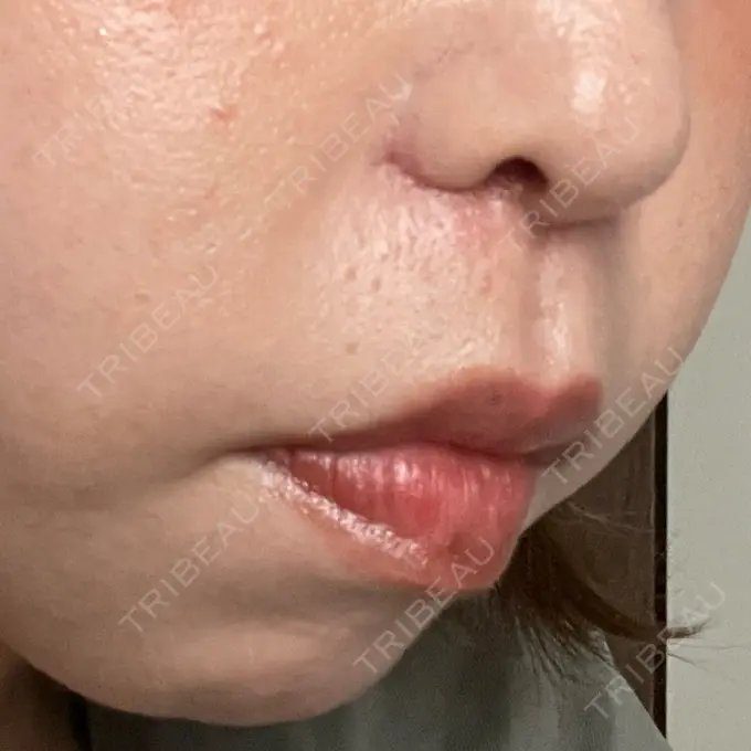 小鼻縮小（切開） / 鼻翼挙上 Otus Clinic 【オータスクリニック】 DAY 16 メイン用