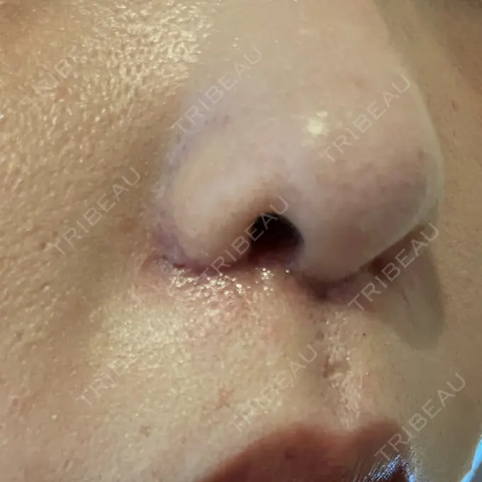 小鼻縮小（切開） / 鼻翼挙上 Otus Clinic 【オータスクリニック】 DAY 23 メイン用