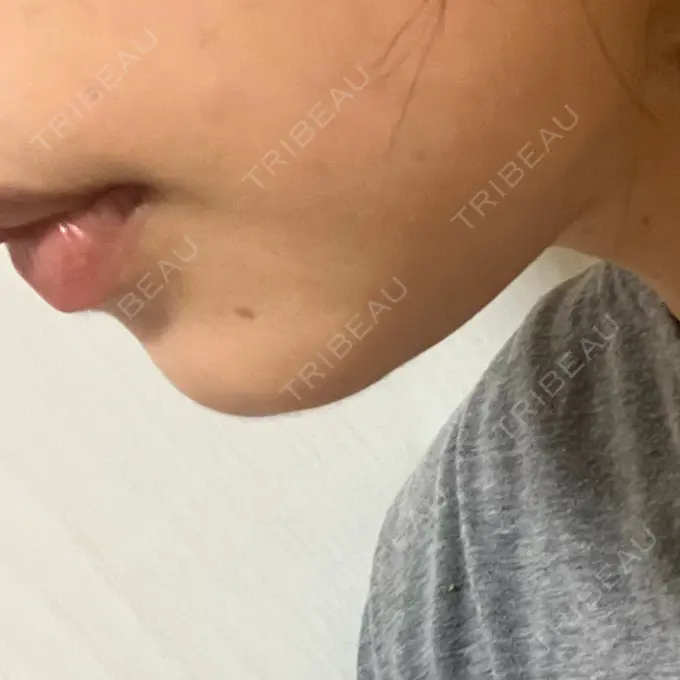 ハイフ（顔） A CLINIC（エークリニック） 仙台院 AFTER メイン用