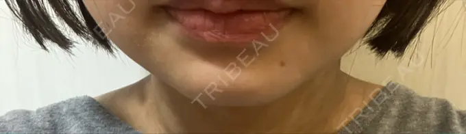 ハイフ（顔） A CLINIC（エークリニック） 仙台院 DAY 29 メイン用