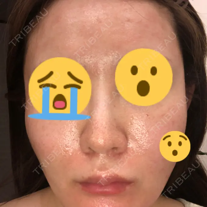 ベビーコラーゲン / ダーマペン ルラ美容クリニック 渋谷本院 AFTER メイン用