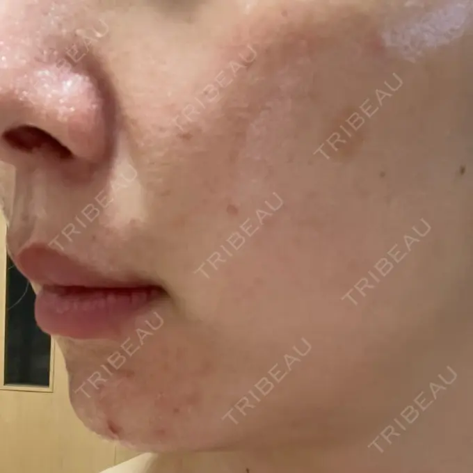 ピーリング（ニキビ・毛穴） / 光治療（フォトフェイシャルなど） MKクリニック 日本橋院 AFTER メイン用