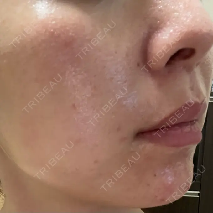 ピーリング（ニキビ・毛穴） / 光治療（フォトフェイシャルなど） MKクリニック 日本橋院 DAY 10 メイン用